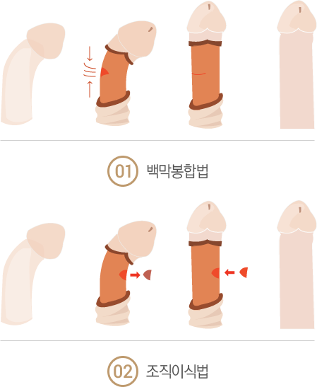 À½°æ¸¸°îÁõÀÇ Ä¡·á(¼ö¼ú¿ä¹ý)